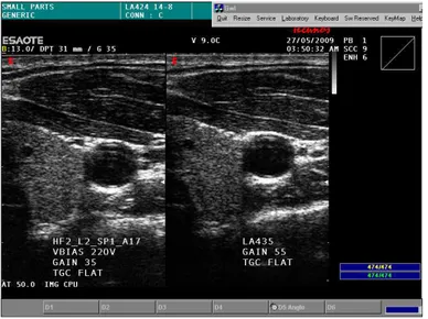 Figura 3.21: Confronto tra immagini ecografiche realizzate con una sonda cMUT (a sinistra) ed una sonda piezoelettrica (a destra).