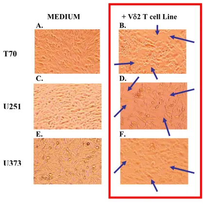 Figure 13. Cytotoxic effect of Vδ2 T cell lines on glioma cells  (microscopic analysis)
