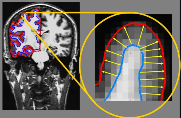 Figura  3:  Ricostruzione  dello  spessore  corticale  come  realizzato  dal  software  Freesurfer