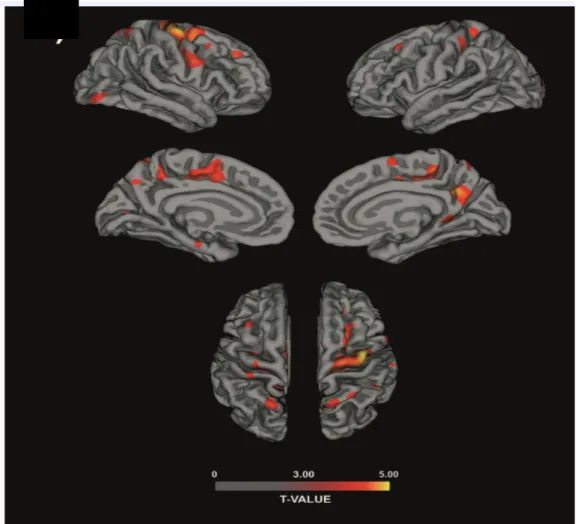 Figura 7: Analisi dello spessore corticale. La barra colorimetrica rappresenta 