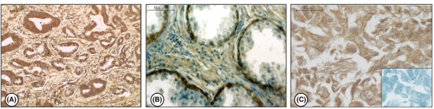 Figure 3 (A) G protein-coupled estrogen receptor (GPER) immunostaining in HGPIN. (B) GPER immunostaining in control prostate