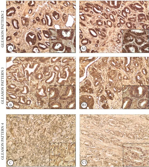 Fig  2. Immunolocalizzazione di GPER nell’adenocarcinoma prostatico. La figura mostra, aree 