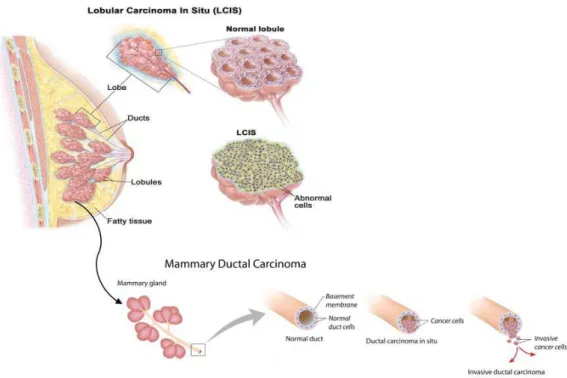 Figure 1.1 |  Representation of the anatomy of the Lobular Carcinoma and Mammary Ductal Carcinoma
