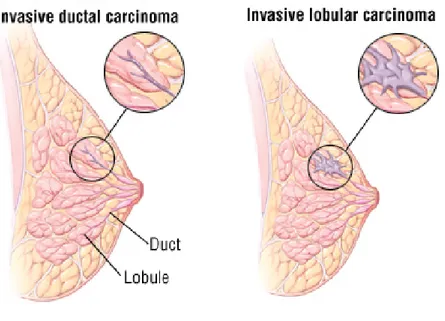 Fig I-6. Invasive ductal carinoma and invasive lobular carcinoma 