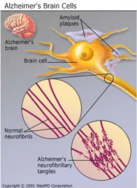 Figura 3.9.  Matasse neurofibrillari e placche amiloidi in cellule neuronali 
