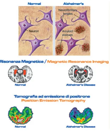 Figura 3.13.  Risonanza Magnetica e Pet per la diagnosi del Morbo di Alzheimer. 