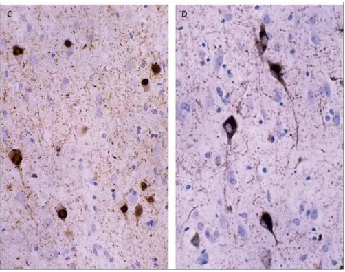 Fig 2. Neurofibrillary tangles in patient with frontotemporal dementia and parkinsonism associated  with chromosome 17 (FTDP-17) (Neary et al., 2005) 