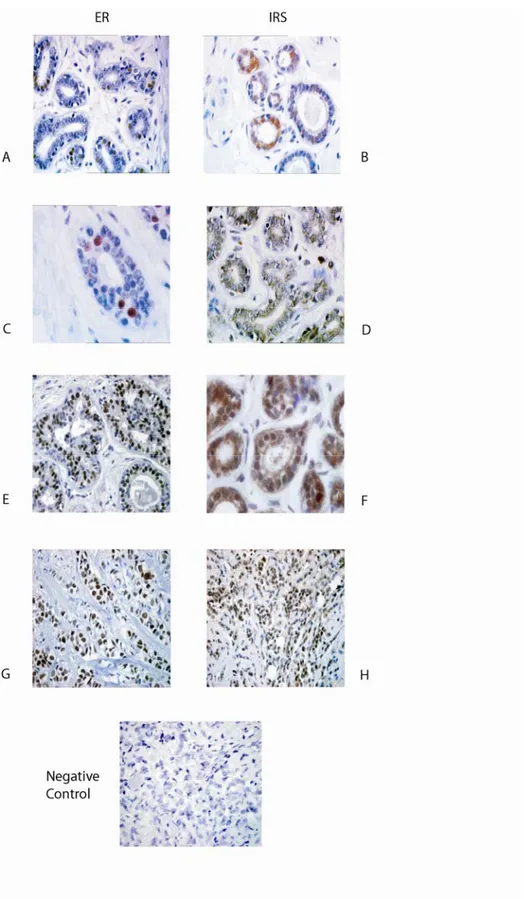 Figure 8. ER α and IRS-1 expression in normal mammary epithelium, benign breast tumors and breast cancers