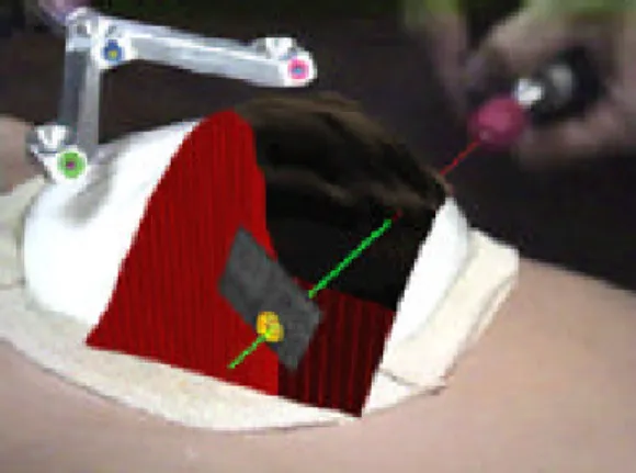 Figure 5: Mockup of breast tumor biopsy. 3-D graphics guide needle  insertion. 