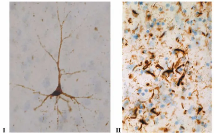 Figure  8  Examples of microscopic neuropathology in tauopathies. Photos are illustrating immuno-