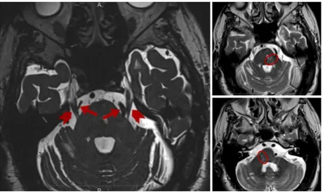 Figure 2 The MRI 3D constructive interference in  steady  state (3D-CISS) image (a)  shows  the  trigeminal  nerve  course  (marked  by  arrowheads)  and  an  arterial  loop  consisting of the superior cerebellar artery on the right side and the vertebral 