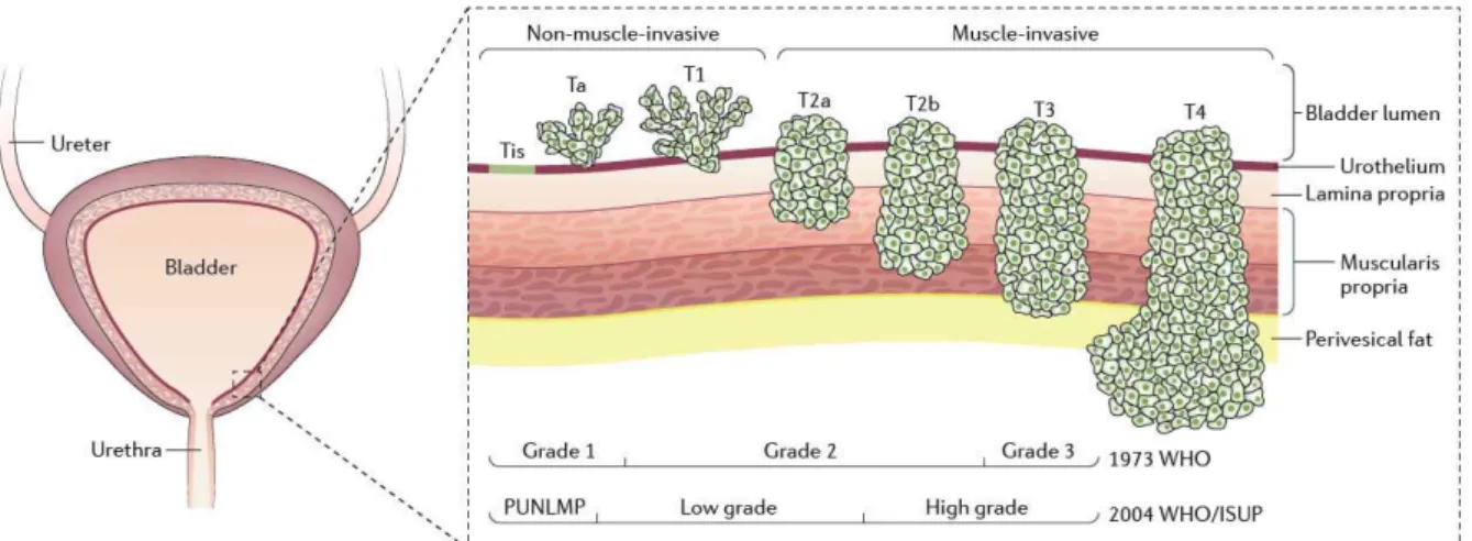 Figura 4 – Storia naturale del tumore vescicale: stadiazione [45] 