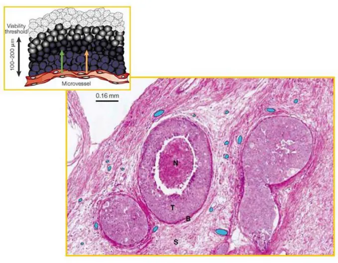 Figura 5 – Crescita del tumore iniziale in assenza di neoangiogenesi e formazione del microambiente  ipossico, ingravescente in ragione della distanza dai vasi