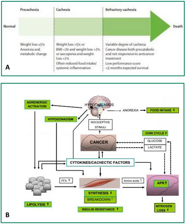 Figura  1.  A)  Rappresentazione  schematica  degli  stadi  della  cachessia  oncologica