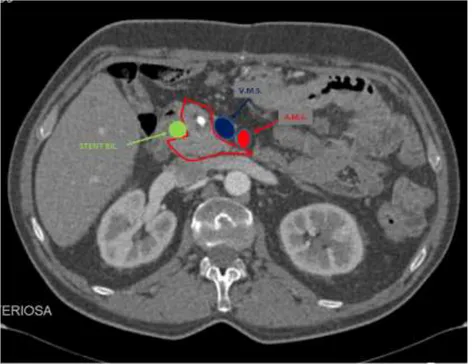 Fig.  8.  Immagine  TC  che  dimostra  in  sezione  assiale  i  limiti 