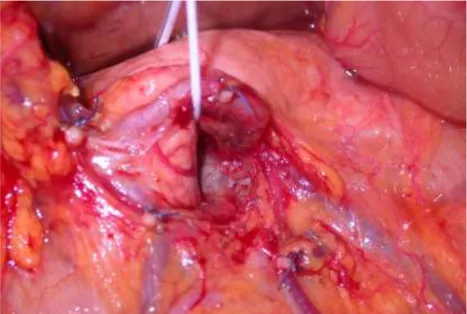Fig. 9 Svincolo dell’istmo pancreatico dall’asse porto-mesenterico: il tumore 