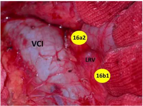 Fig.  14  Dissezione  retro-pancreatica  delle  regioni  16a2  e  16b1  (VCI  vena 
