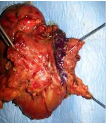 Fig.  3.  Preparato  operatorio  di  DCP  con  exeresi  del  mesopancreas.  Si 