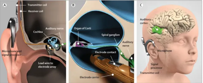 Figure 1.6 Components of cochlear implant. 1: microphone, linked to speech processor; 2: transmitter  coil; 3: receiver electronics; 4: electrodes array; 5: acoustic nerve 