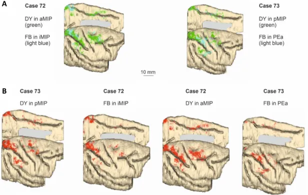 Fig. 5. 3D reconstruction of the lateral and mesial aspects of the brains, showing the cortical distribution 