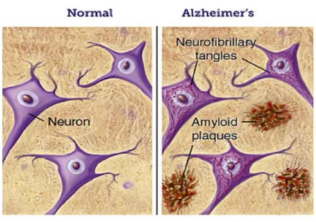 Figura 4. Formazione di grovigli neurofibrillari e placche senili  nella malattia di Alzheimer 