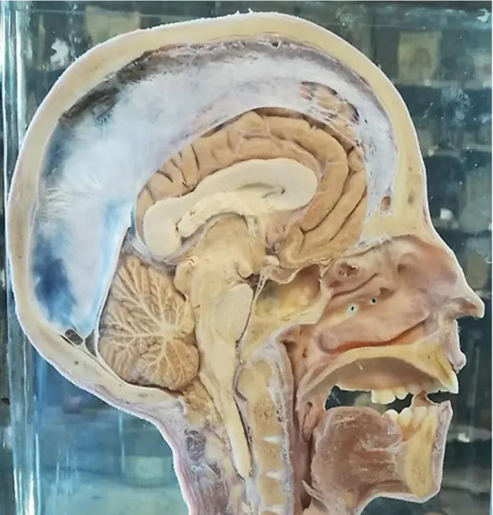 Fig. 6. Museo Anatomico  Morelli dell’Ospedale  C. Forlanini  di  Roma. Preparato  in  Formalina della sezione sagittale della testa