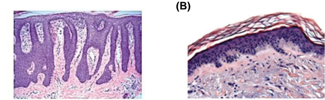 Figure  5.  The  role  of  angiogenesis  in  psoriasis.  Psoriasis  histology.  (A)  H&amp;E  staining  of  psoriasis skin