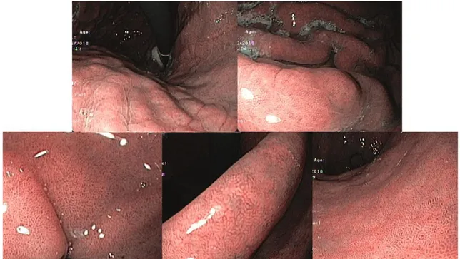 Figure 2. Example of an upper gastrointestinal endoscopy with NBI without 