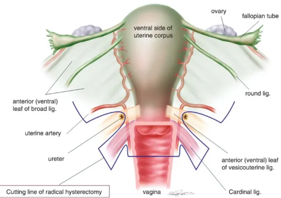 Figura  4  –  Isterectomia  radicale  (modificata  da  Fujii  S,  Precise  Neurovascular  Anatomy for Radical Hysterectomy 2019)