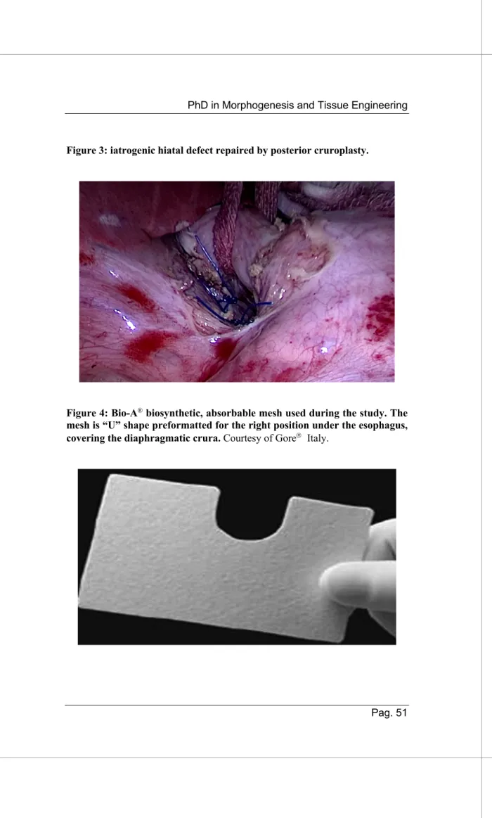 Figure 3: iatrogenic hiatal defect repaired by posterior cruroplasty. 