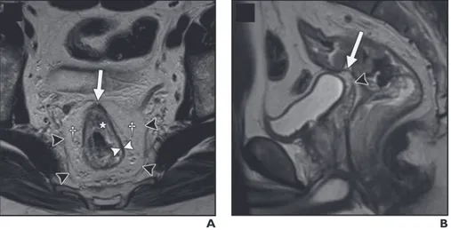 Figure  1—Rectal  anatomy  on  MRI.    A,  Axial  T2-weighted  image  in  65-year-old  man  shows  muscularis  propria as hypointense band (white arrowheads) between mesorectal fat and submucosa (asterisk)