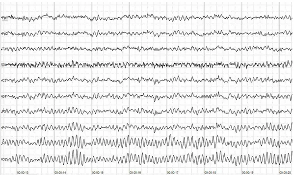 Figura 3. Esempio di tracciato EEG. Ogni traccia viene registrata da un elettrodo diverso, 