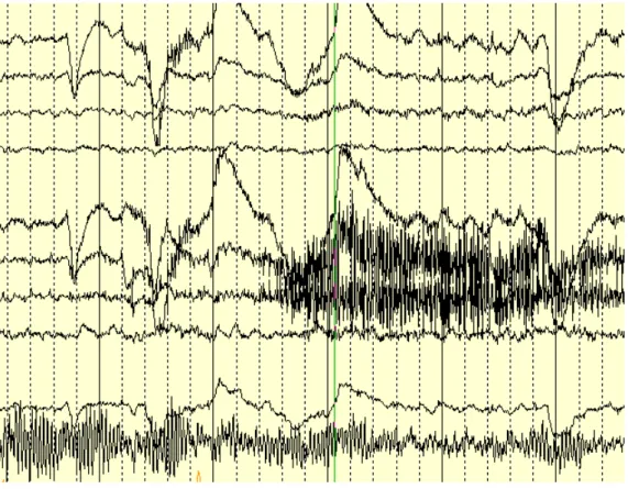 Figura 3. Esempio di artefatti del tracciato EEG. Questi vanno rimossi prima di effettuare 