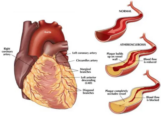 Figura   5.   Evoluzione   del   processo   aterosclerotico   e   variazioni   del   lume   arterioso   nelle   diverse  fasi