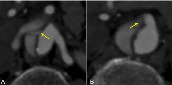 Fig. 8 Coinvolgimento dei vasi viscerali: il flap di dissezione (freccia) si estende all’ostio dell’arteria renale 