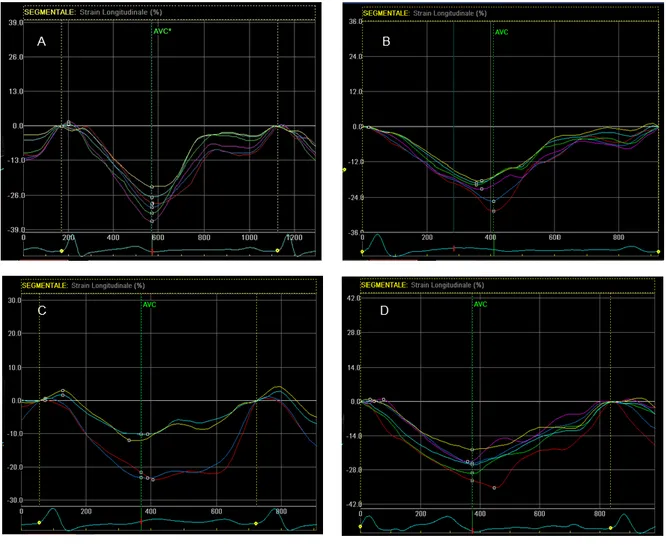 Figure  10.  Right  ventricular  strain-derived  patterns  by  speckle  tracking  echocardiography