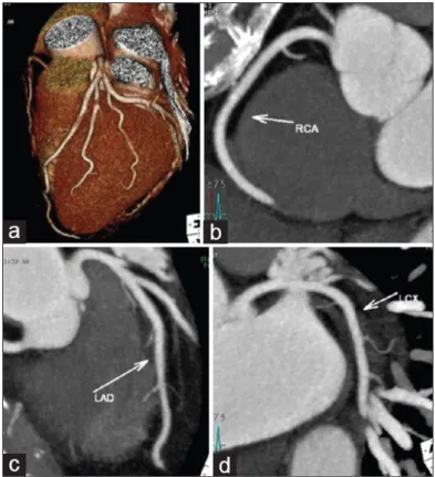 Figura 6. Ricostruzioni Volume Rendering (a), MIP (b, c, d) del cuore e delle arterie  coronariche