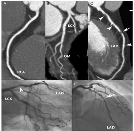 Figura 12. Uomo di 59 anni con dolore toracico acuto irradiato ad entrambe le braccia che si  era attenuato dopo somministrazione di nitroglicerina sublinguale