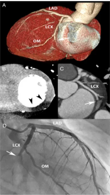 Figura 13. Infarto miocardico in un’uomo di 48 anni con dolore toracico acuto.  