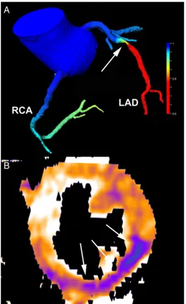 Figura 14. Valutazione colorimetrica della significatività emodinamica con Cardio-TC in una  stenosi dell’arteria discendente anteriore al tratto medio (LAD)