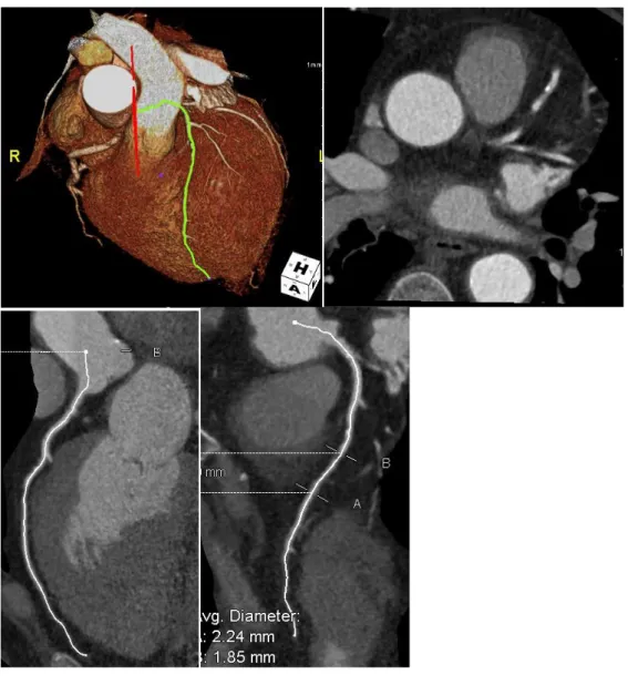 Fig.  19:  Paziente  2  ZB    2010;  minima  irregolarità  parietale  mista  a  livello  del  tratto  distale  dell’arteria discendente anteriore con stenosi lieve del lume vasale