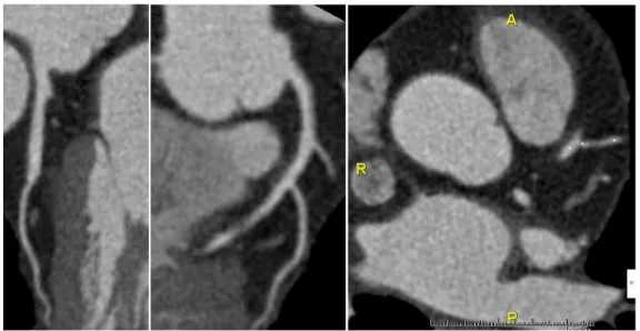 Fig.  21:  Paziente  3  FL  2010;  assenza  di  lesioni  parietali  di  rilievo  a  carico  dell’arteria  discendente anteriore e dei rami diagonali