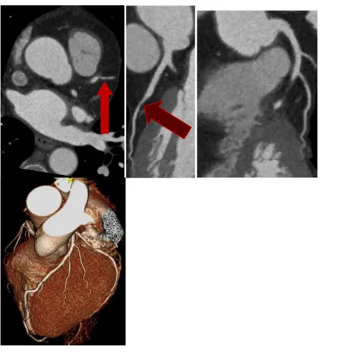 Fig.  22:  Paziente  3  FL  2015;  evoluzione  severa  dell’ateromasia  coinvolgente  l’origine  del  II  ramo  diagonale,  interessato  da  una  placca  morbida  eccentrica  che  determina  stenosi  significativa del lume vasale