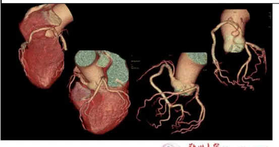 Fig. 23: Occlusione al terzo prossimale della coronaria destra con riabitazione del vaso da  circolo anastomotico etero coronarico in paziente di 69 anni in terapia antiretrovirale da 120  mesi; le ricostruzioni multiplanari documentano la presenza di una 