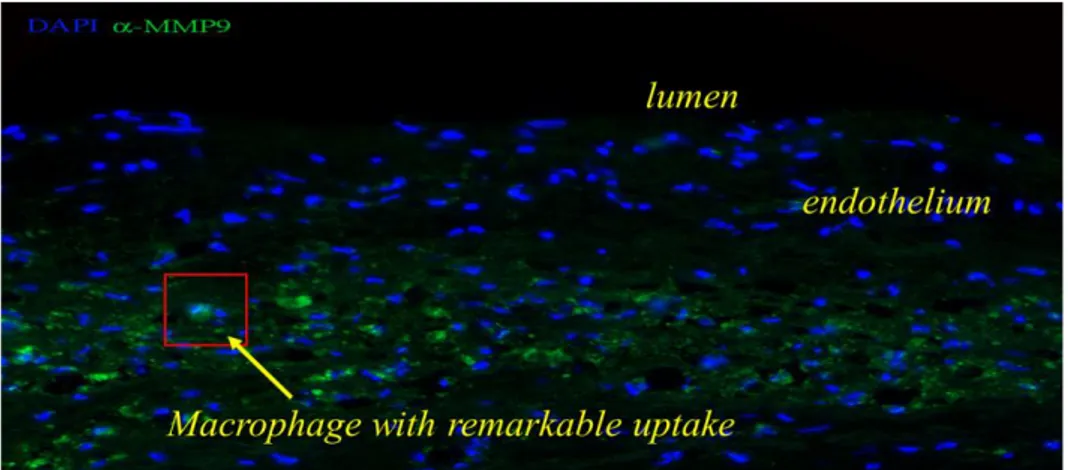 Figura  1.4  Immunofluorescenza  della  placca  aterosclerotica  carotidea.  Sono 