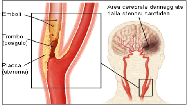 Figura  1.7  Meccanismo  trombo-embolico:  ischemia 