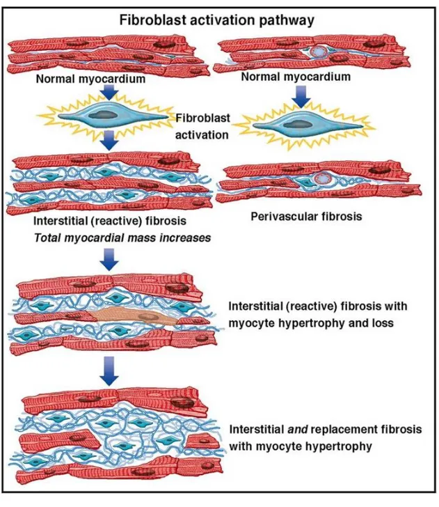 Figure  4.  Compensatory  cardiac  remodeling  of  the  remote  myocardium  leads  to  the  reactive  fibrosis