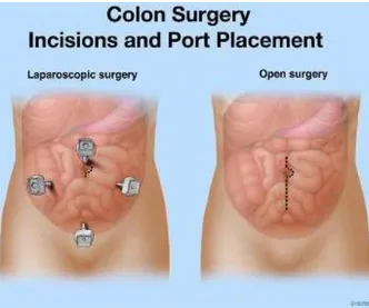 Figure 2.1. Colon surgery: Laparoscopic surgery vs open surgery (Reproduced  from [12]) 