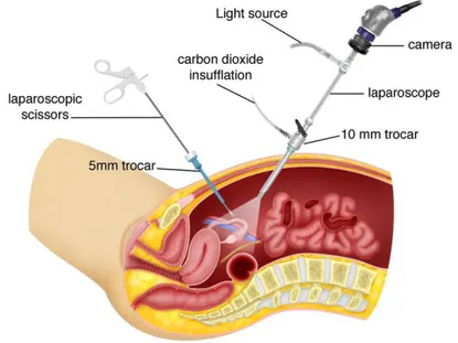 Figure 2.2. Overview about laparoscopic surgery (Reproduced from [20])  