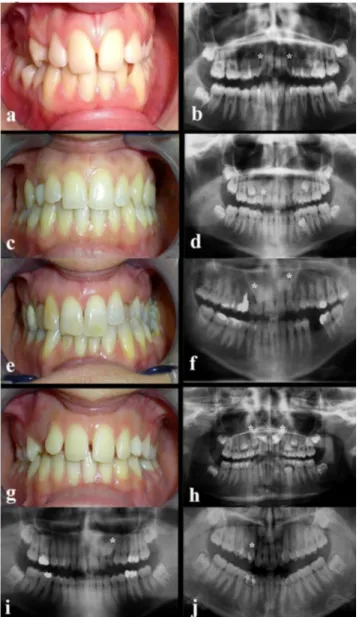 Figure 14. Clinical photographs and panoramic radiographs of dentitions of six affected family members
